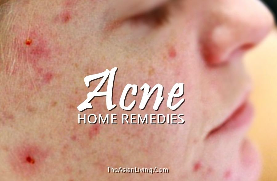 BEST HOME ACNE REMEDIES