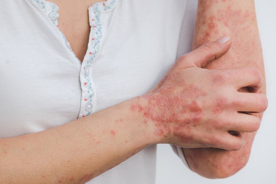 Control Psoriasis by Boosting Immunity